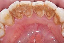 Tooth Discoloration