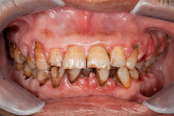 Gingivitis