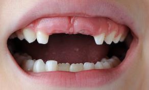 Hypodontia