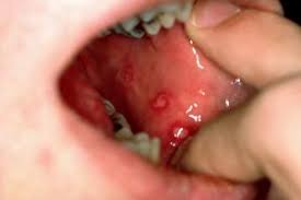 Mouth Ulcer